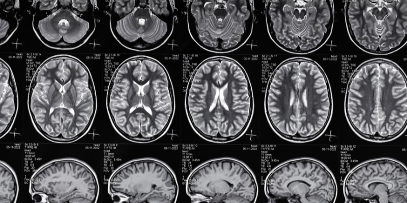 High-Fat Diet and Cognitive Function