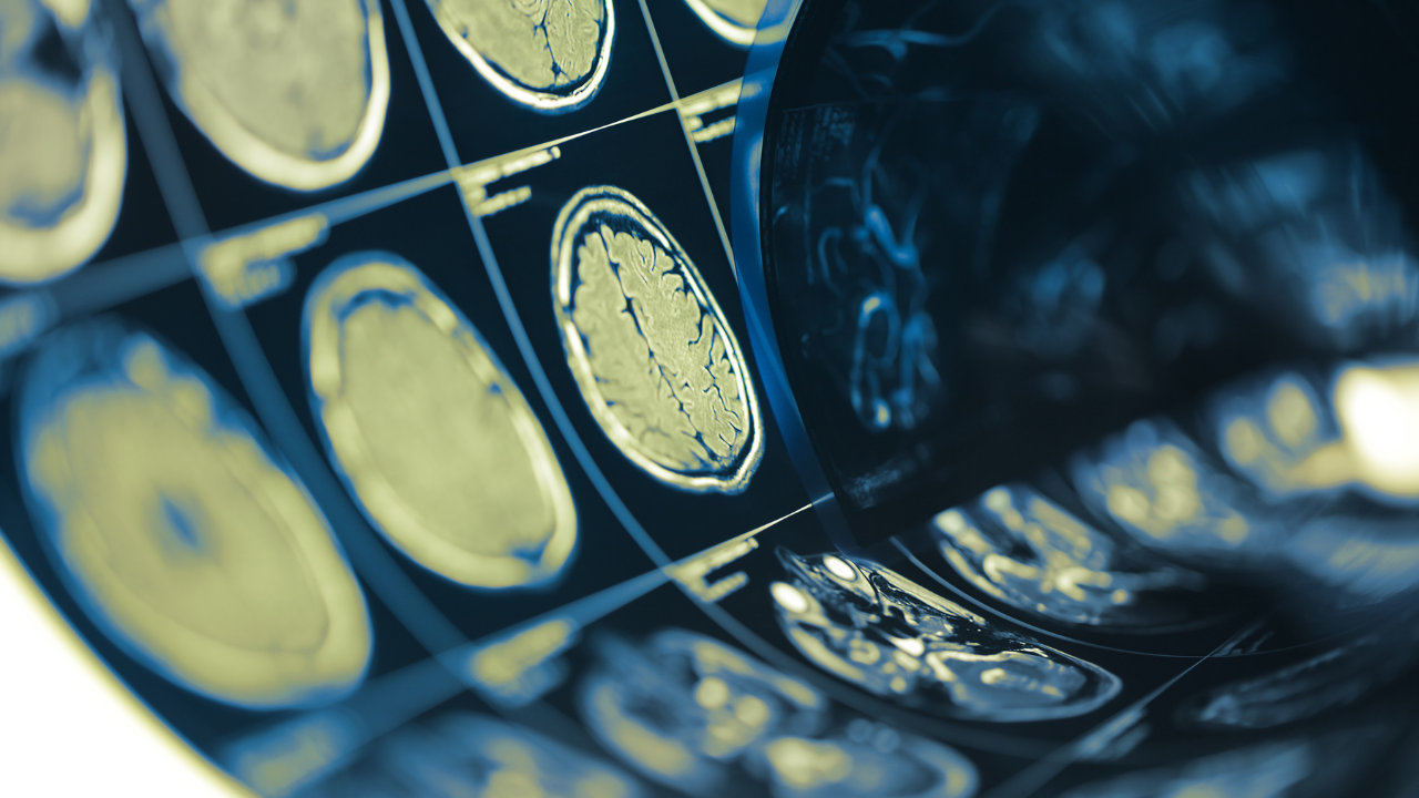How Poor Nutrition Affects Mental Health: The Link Between Diet and Mood
